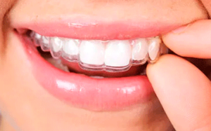 How Long Does Invisalign Take