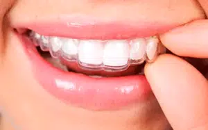 How Long Does Invisalign Take