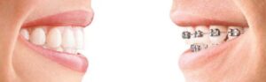 braces vs invisalign