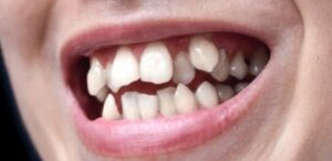 Overcrowded teeth