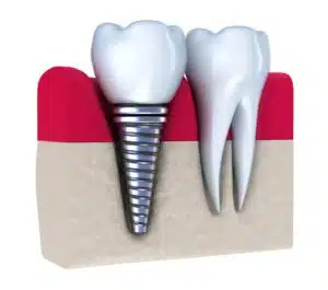 Illustration explaining dental implants healing time