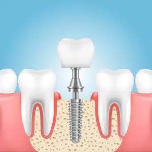 Dental implant healing time timeline after implant surgery