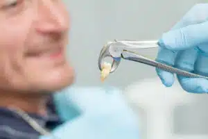 Doctor showing extracted tooth after oral dental surgery